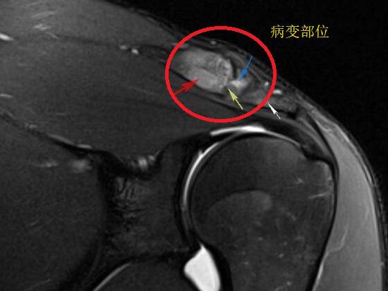 锁骨病变