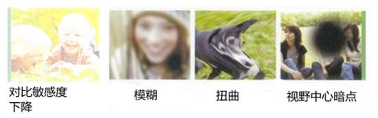 黄斑病变的视力影响