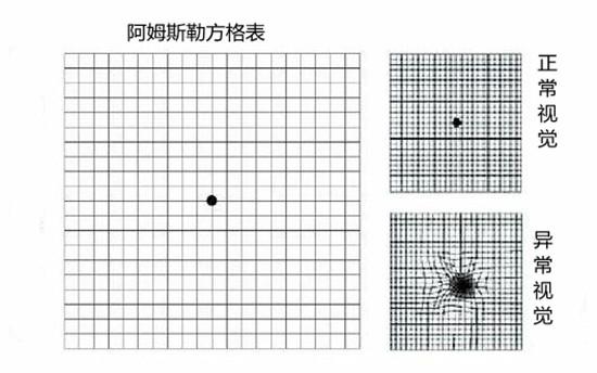 老年性黄斑变性后的视觉感受