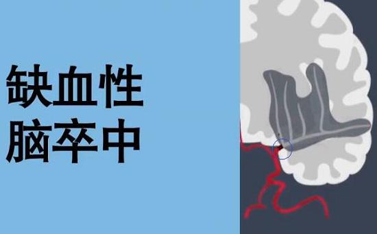 缺血性脑卒中