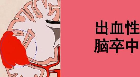 出血性脑卒中