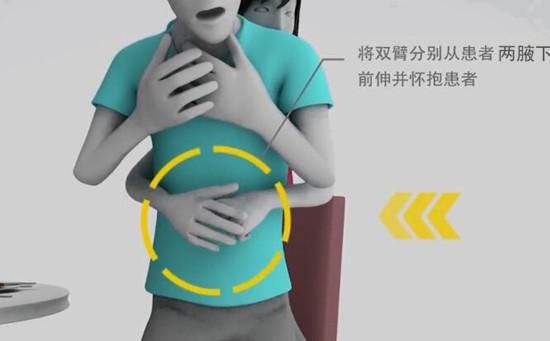 海姆立克急救法