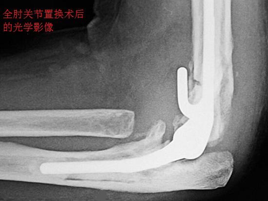 全肘关节置换术后