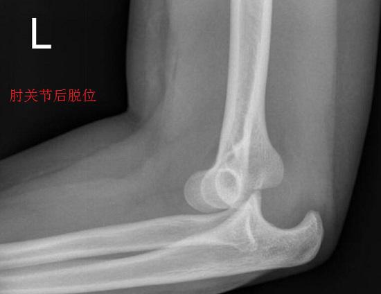 肘关节后脱位