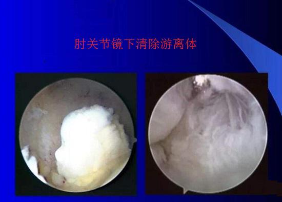 关节镜下清除游离体