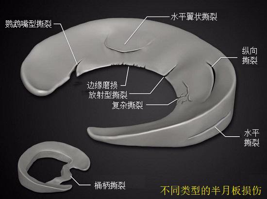 半月板损伤的类型