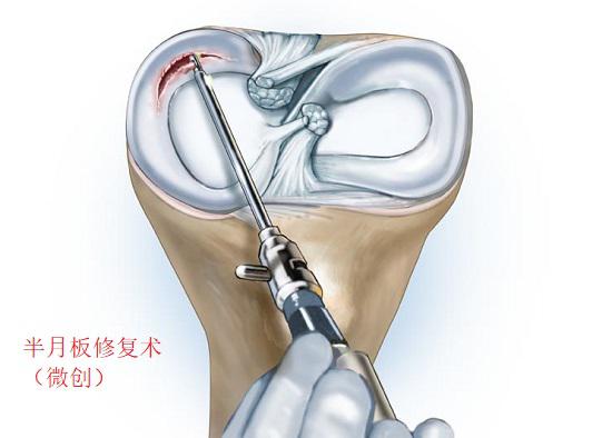 半月板修复术