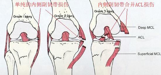 不同类型的内侧副韧带损伤
