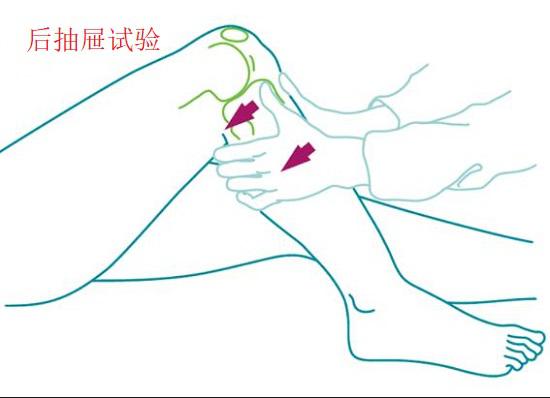 后抽屉试验（用来诊断后交叉韧带损伤）