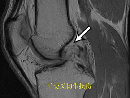 后交叉韧带损伤的MRI影像资料