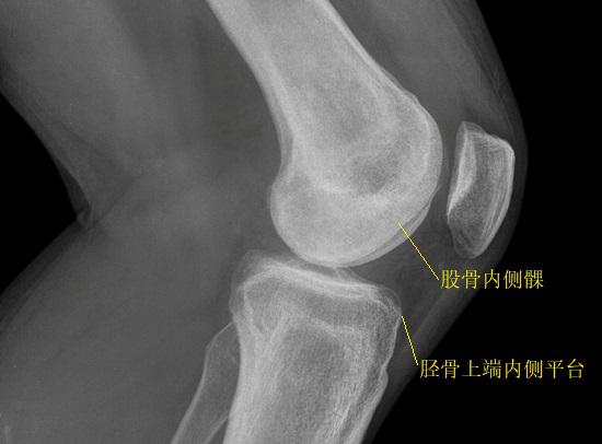 胫骨及股骨的骨性标志