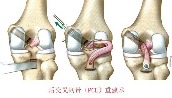 后交叉韧带重建术