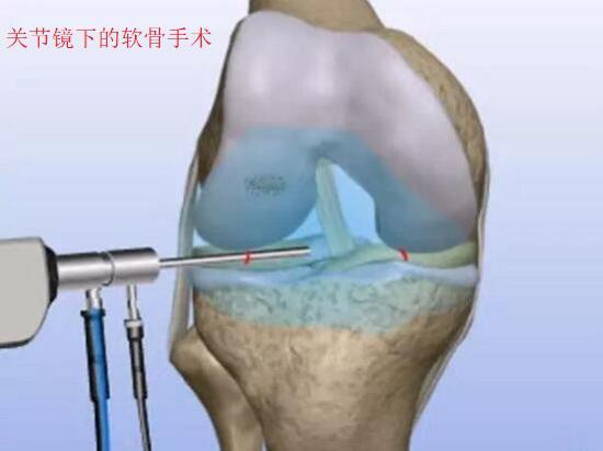 关节镜下的软骨手术