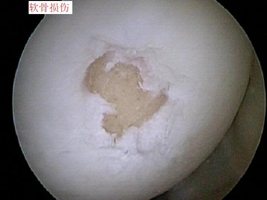 剥落的软骨及暴露的软骨下骨