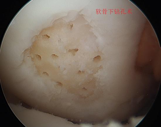 软骨下钻孔术