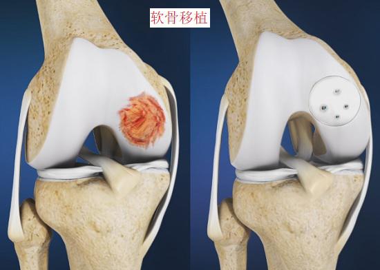 软骨移植