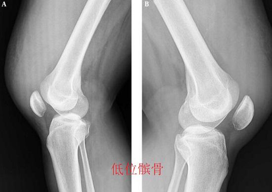 髌骨位置及活动范围异常