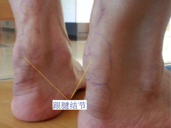 跟腱结节