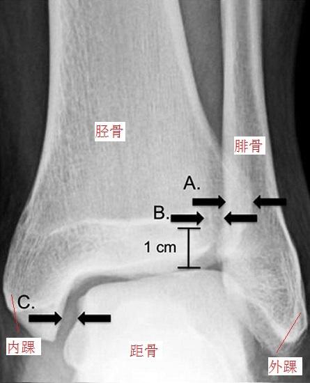 踝关节及下腓胫联合体的光学影像