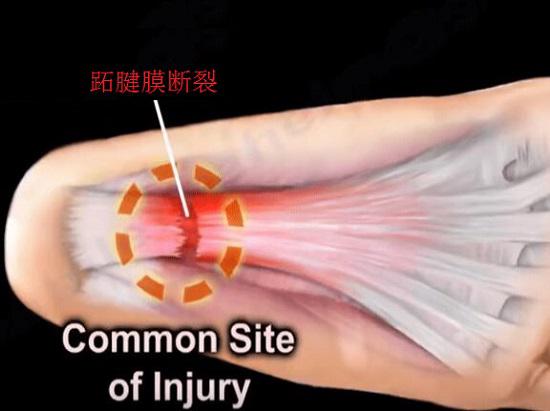 跖腱膜断裂