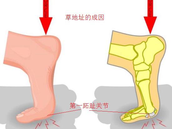 草地趾的成因