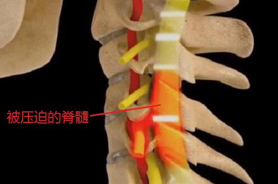 脊髓型颈椎病