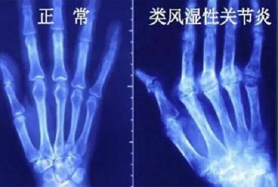 关节变形