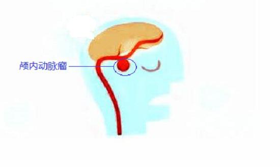 颅内动脉瘤