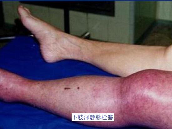 下肢深静脉栓塞的症状