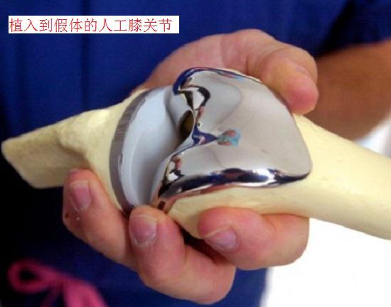 人工膝关节