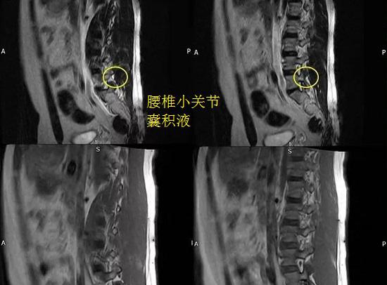 组织畸形（腰椎小关节囊损伤及积液）