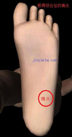骰骨综合征的痛点