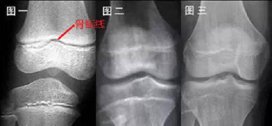 骨骺线闭合过程