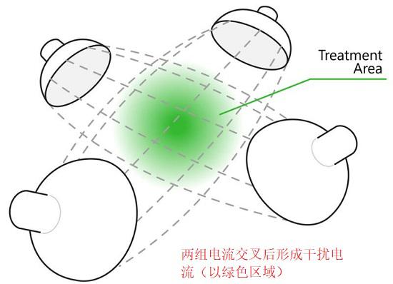 两组电极交叉以形成干扰电流