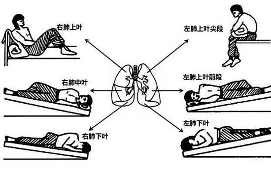 体位引流排痰法