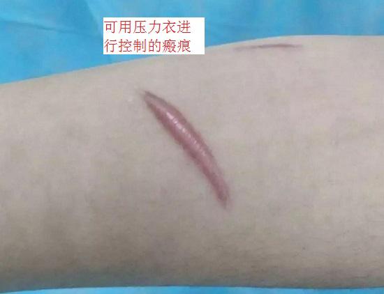 皮肤瘢痕