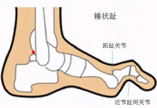 锤状趾