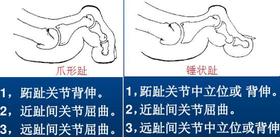 锤状趾与爪形趾