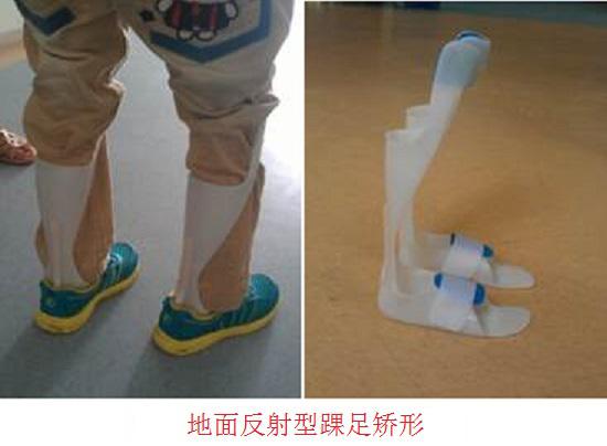地面反射型踝足矫形器