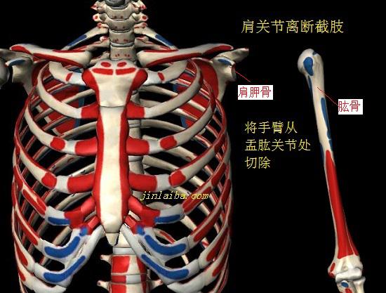 肩关节离断截肢