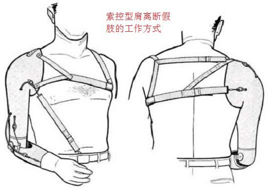 索控型肩离断假肢的工作方式