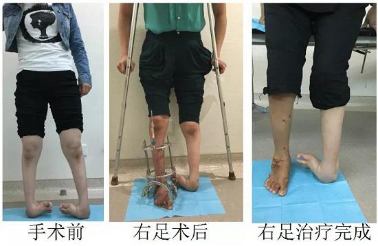 马蹄内翻足的手术治疗