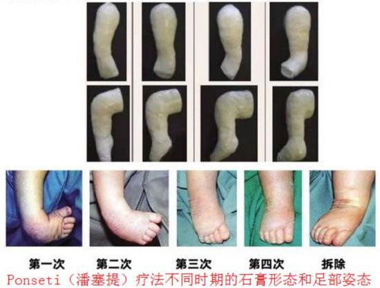 马蹄内翻足的保守治疗