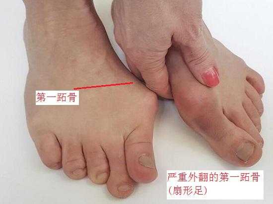 扇形足