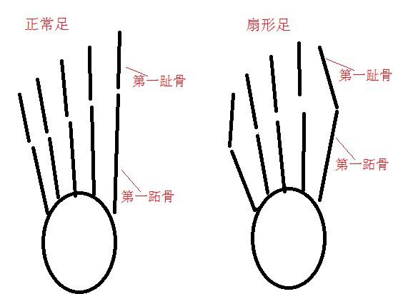 正常足与扇形足