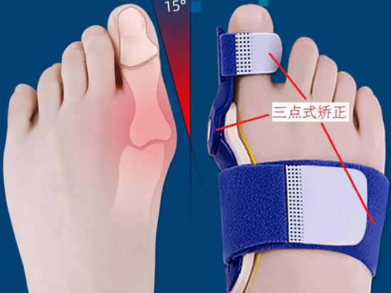 扇形足矫形器