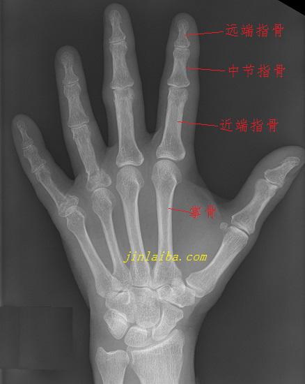 X光片下的手部骨骼