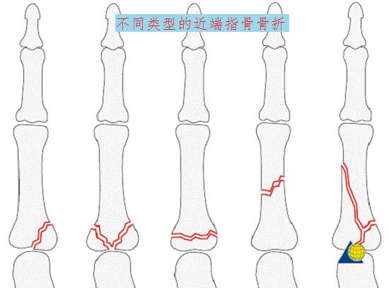 不同类型的近端指骨骨折