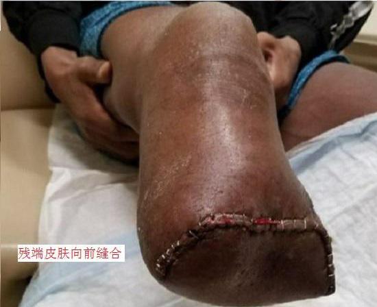 小腿截肢术后（可能会有瘢痕形成）