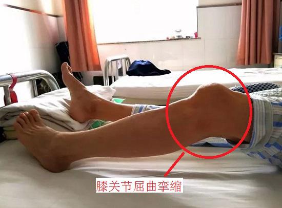 膝关节屈曲挛缩